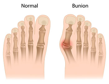 lapiplasty 3d bunion correction