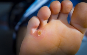 Is It a Corn, or a Callus?
