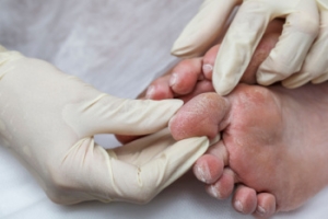Diabetes and Your Feet
