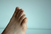 Facts About Corns on the Feet