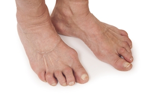 Symptoms and Affected Joints of RA in the Feet