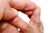 Causes and Prevention of Athlete’s Foot