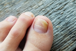 White Spots on Toenails