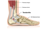 How Did I Hurt My Achilles Tendon?